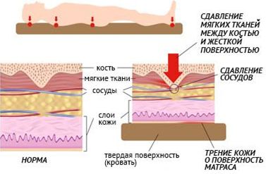 Профилактика пролежней: мероприятия, СОПы, памятки Механизм образования пролежней у пациента: памятка