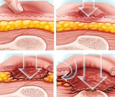 Профилактика пролежней: мероприятия, СОПы, памятки Мероприятия по профилактике пролежней