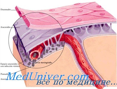ушной менингит