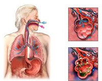 Аспирационная пневмония Аспирационная пневмония