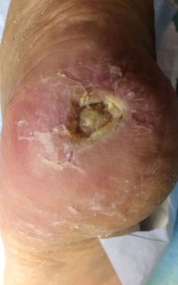 Промежуточный результат. Обработка раны специализированными мазями и составами. Чистка пролежня. Перевязки. Image