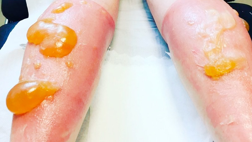 Ожог второй степени - виды ожогов. Стерильно.com