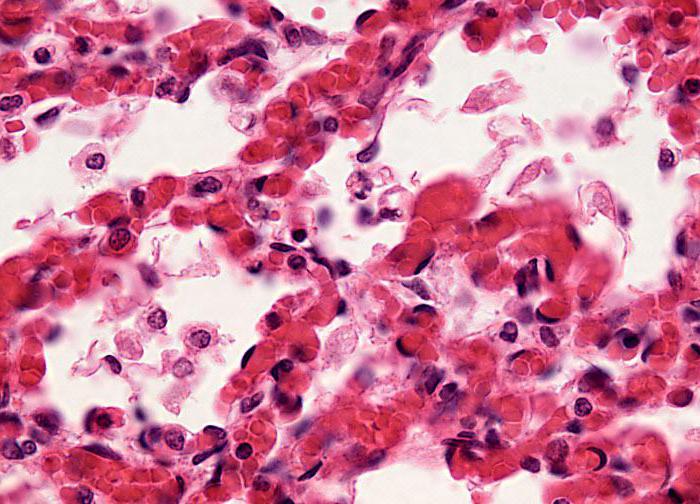 пневмония как передается