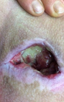 Динамика лечения пролежня на копчике, промывка и обработка раны от гноя, наложение специально подготовленных мазей. Image