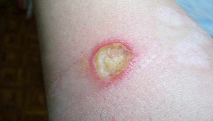 Как лечить ожог с гнойничками