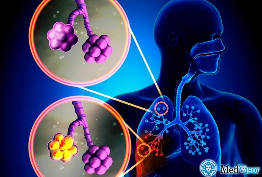 Пневмония без уточнения возбудителя Пневмония лечение и бронхита у