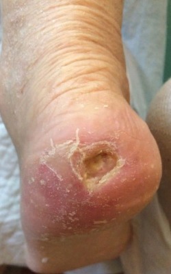 Заключительная стадия лечения. Гнойных выделений нет. Пролежень подсох и заживает. Благоприятный прогноз на полное заживление. Image