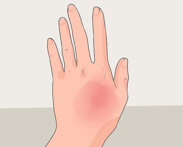 психосоматика ожога на левой руке