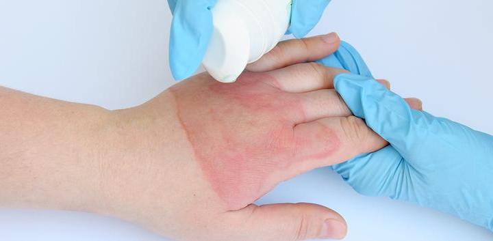 ожог на руке