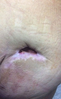 Значительное уменьшение и прогноз на дальнейшее излечение пролежня. Гноя нет, стадия активного заживления. Image