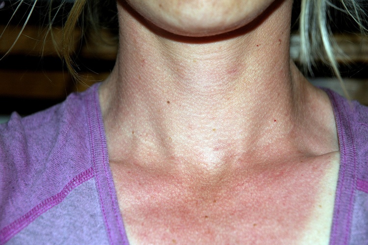 Ожог от солнца лечение зуд