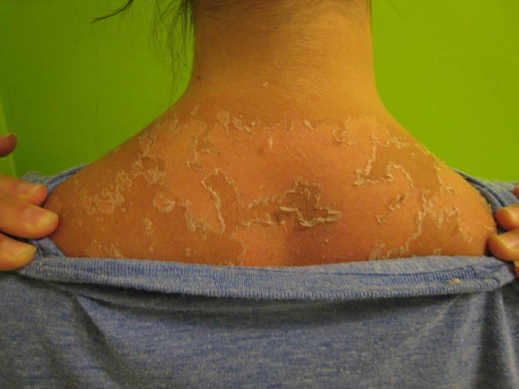 Мазь от темных пятен при ожогах