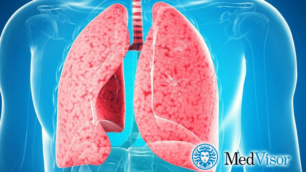 Может ли бронхит перейти в пневмонию? Пневмония лечение и бронхита у