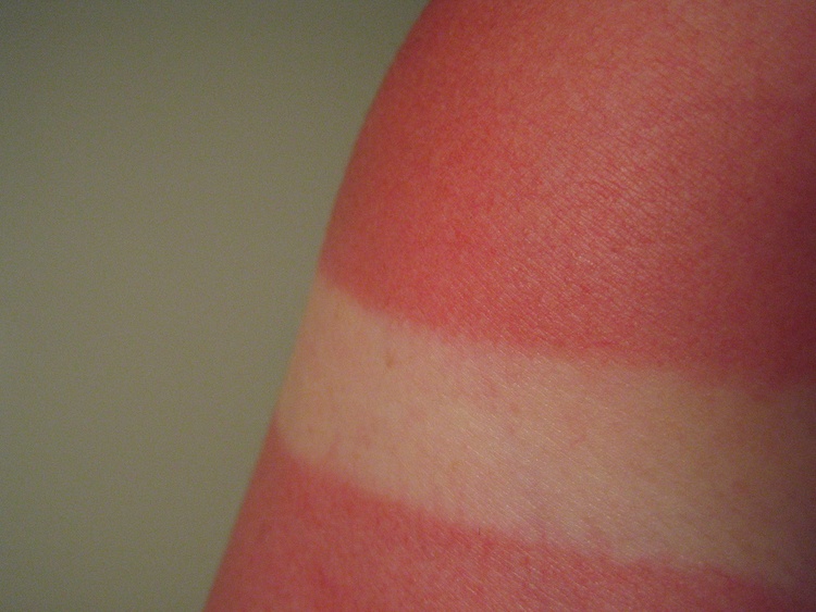 Самое лучшее средство солнечных ожогов