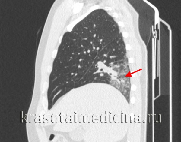 КТ органов грудной клетки. Участок воспалительной инфильтрации (пневмония) в задних каудальных отделах нижней доли правого легкого КТ органов грудной клетки. Участок воспалительной инфильтрации (пневмония) в задних каудальных отделах нижней доли правого легкого