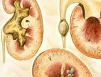 Подагрическая нефропатия Подагрическая нефропатия