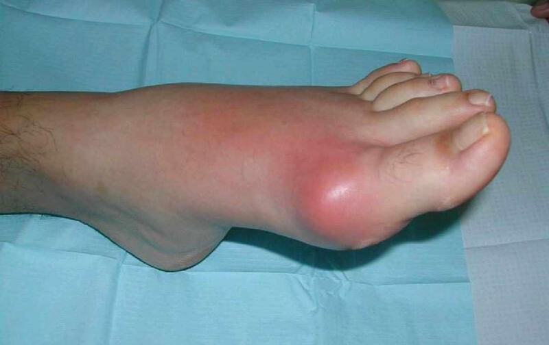 Подагра и сахарный диабет: как сосуществуют, особенности питания Подагра и сахарный диабет: как сосуществуют, особенности питания