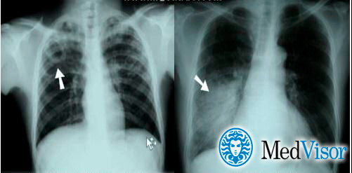 Отличия пневмонии от туберкулеза на рентгене Как отличить пневмонию от туберкулеза на рентгенограмме