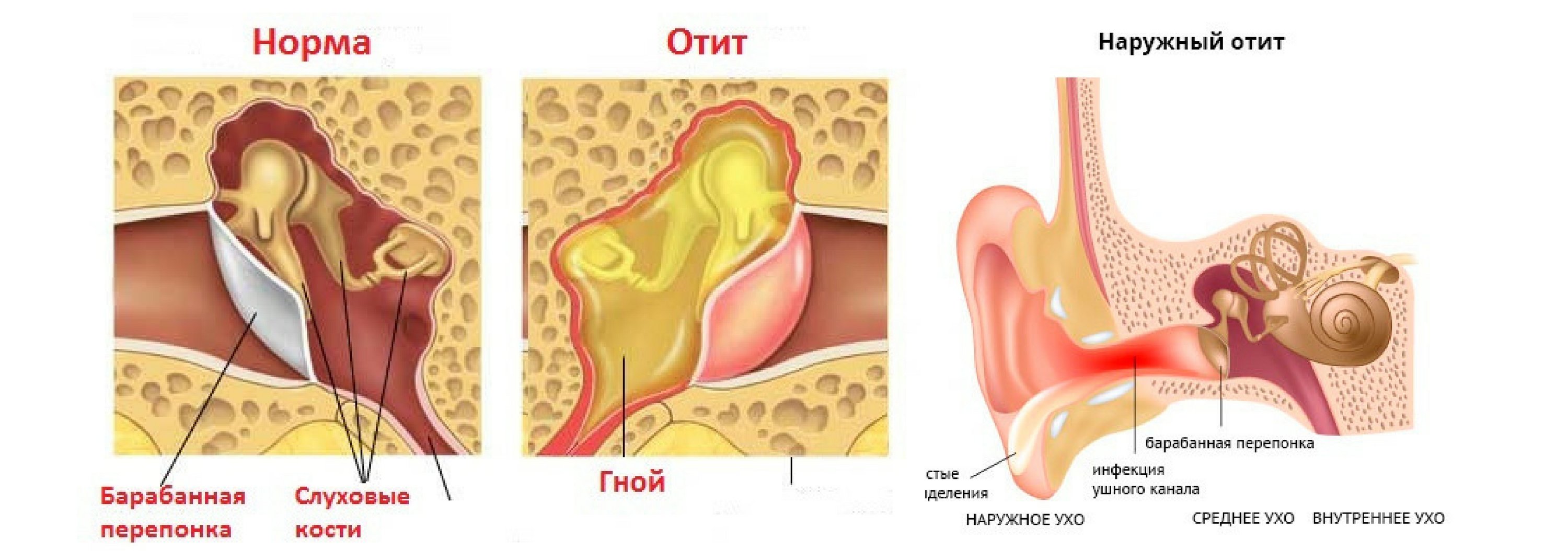 берут ли в армию с отитом