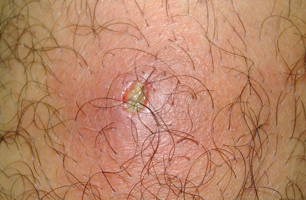 Применяется при фурункулах