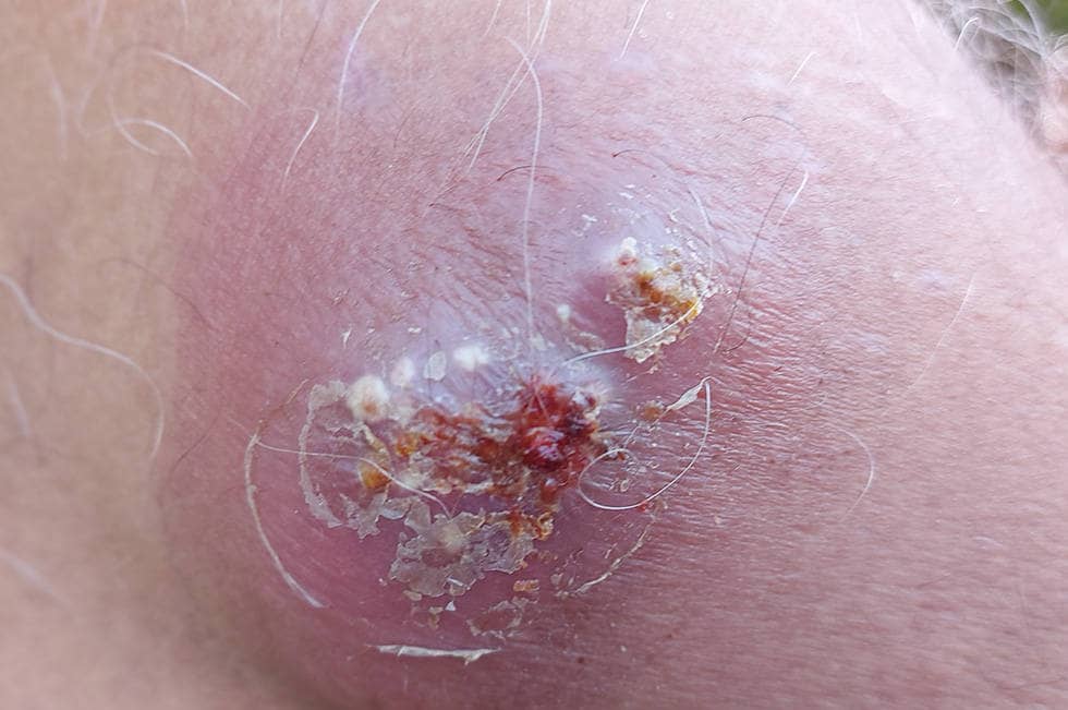 Применяется при фурункулах