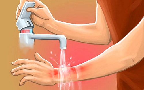 Первая помощь при химических ожогах