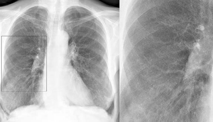 Бронхит на рентгеновском снимке
