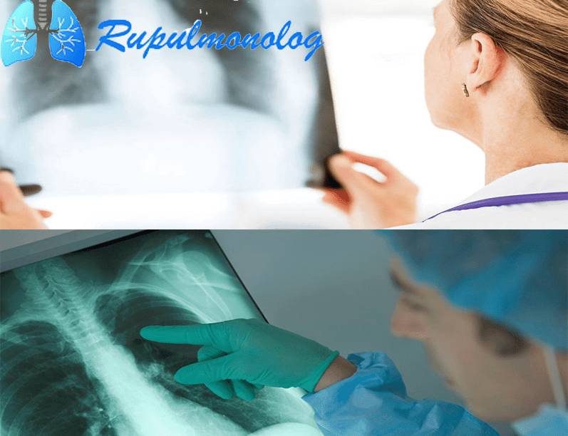 Прикорневая пневмония