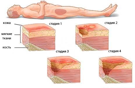 Как выглядят пролежни, 4 стадии (схематично) Как выглядят пролежни, 4 стадии (схематично)