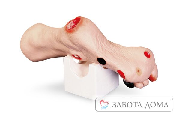 Пролежни на пятках Пролежни на пятках