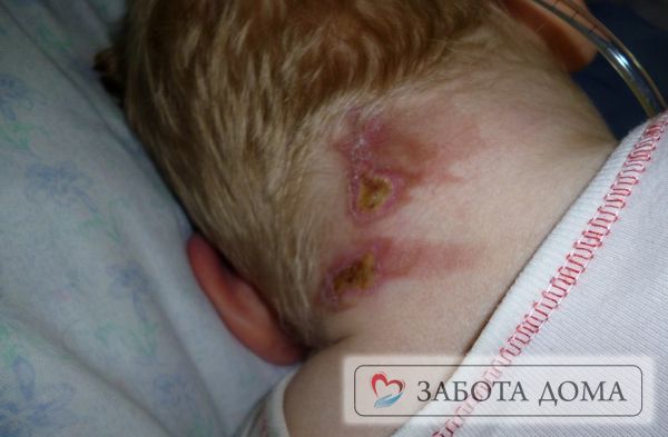 Постепенно процесс отмирания тканей увеличивается, затрагивая прилежащие области Пролежни у ребенка на затылке