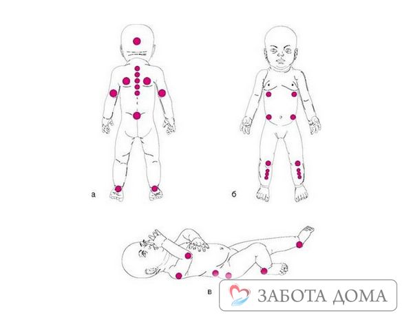 Это самые уязвимые зоны, которые сдавливаются весом малыша в положении лежа Схема локализации пролежней у ребенка