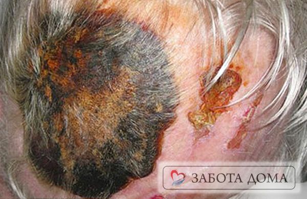 Пролежень на голове Пролежень на голове