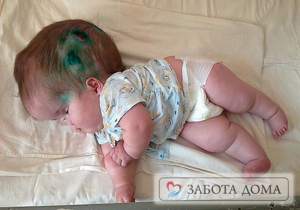 Пролежни на голове у новорожденного ребёнка, который подвержен какому-либо заболеванию формируются в 90% случаев, так как чаще всего дети ещё не способны самостоятельно держать голову. Пролежни на голове у ребенка (грудничка)