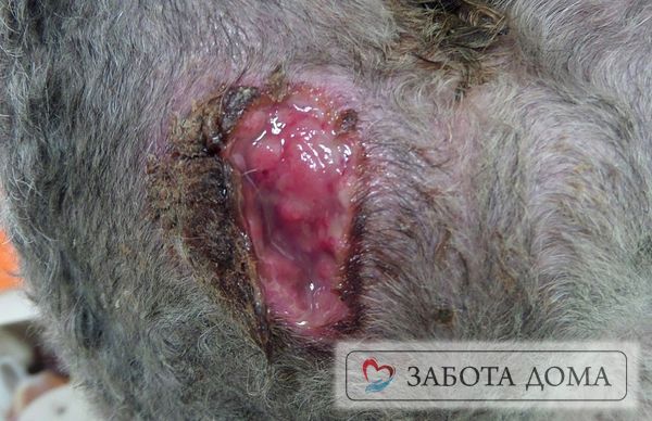 Наличие волос на голове может стать источником заражения раны микроорганизмами. Помимо этого, при недостаточном уходе или невнимательном отношении к больному – волосы мешают вовремя обнаружить пролежень. Опасность пролежня на голове