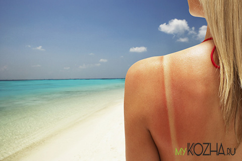 Солнечный-ожог