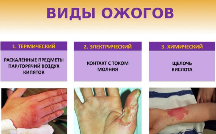 виды ожогов