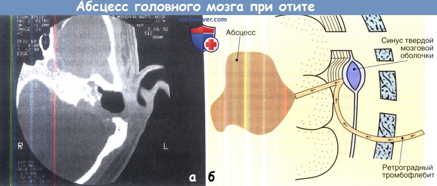 Абсцесс головного мозга при отите