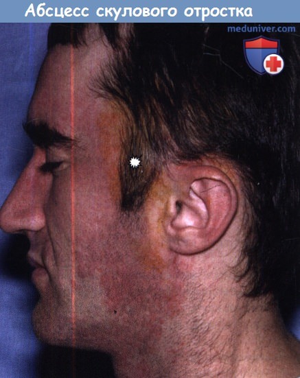 Абсцесс скулового отростка