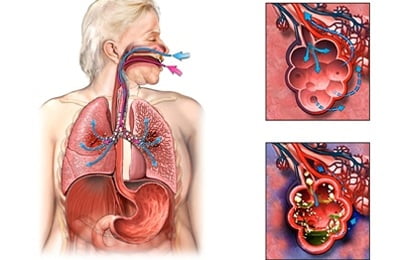 Воспаление легких