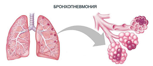 Бронхопневмония (бронхиальная пневмония, очаговая пневмония) Бронхопневмония (бронхиальная пневмония, очаговая пневмония)