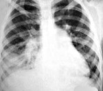 Аспирационная пневмония Аспирационная пневмония