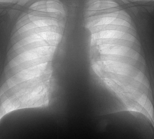 Флюорография