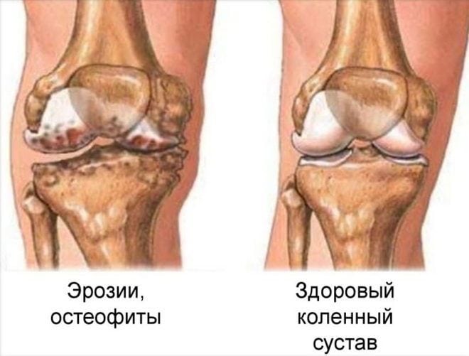 Остеоартроз коленного сустава это подагра