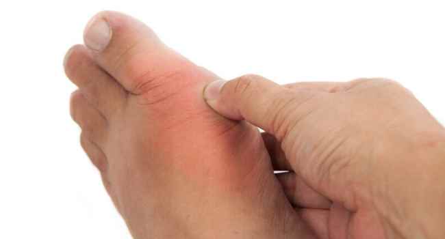 эфирные масла при подагре-список-рецепты