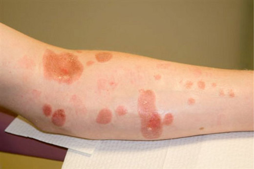 ожог на руке от извести