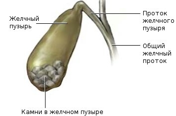 размер камней в желчном пузыре