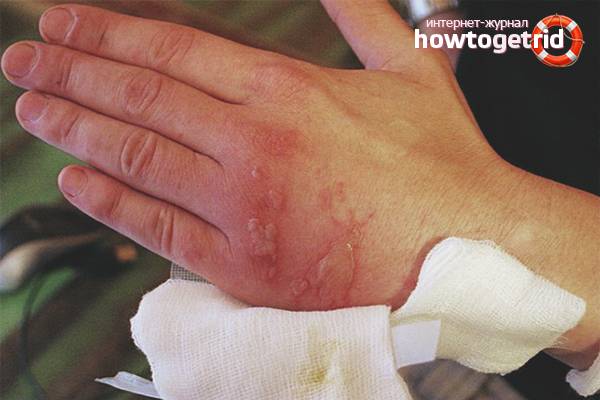 Как снять боль при ожоге