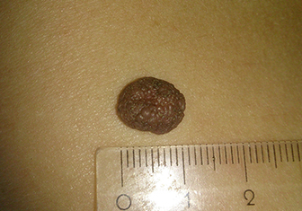 После травмы за родинкой нужно наблюдать. После травмы за родинкой нужно наблюдать.