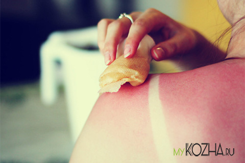 лечение-солнечного-ожога-народными-средствами